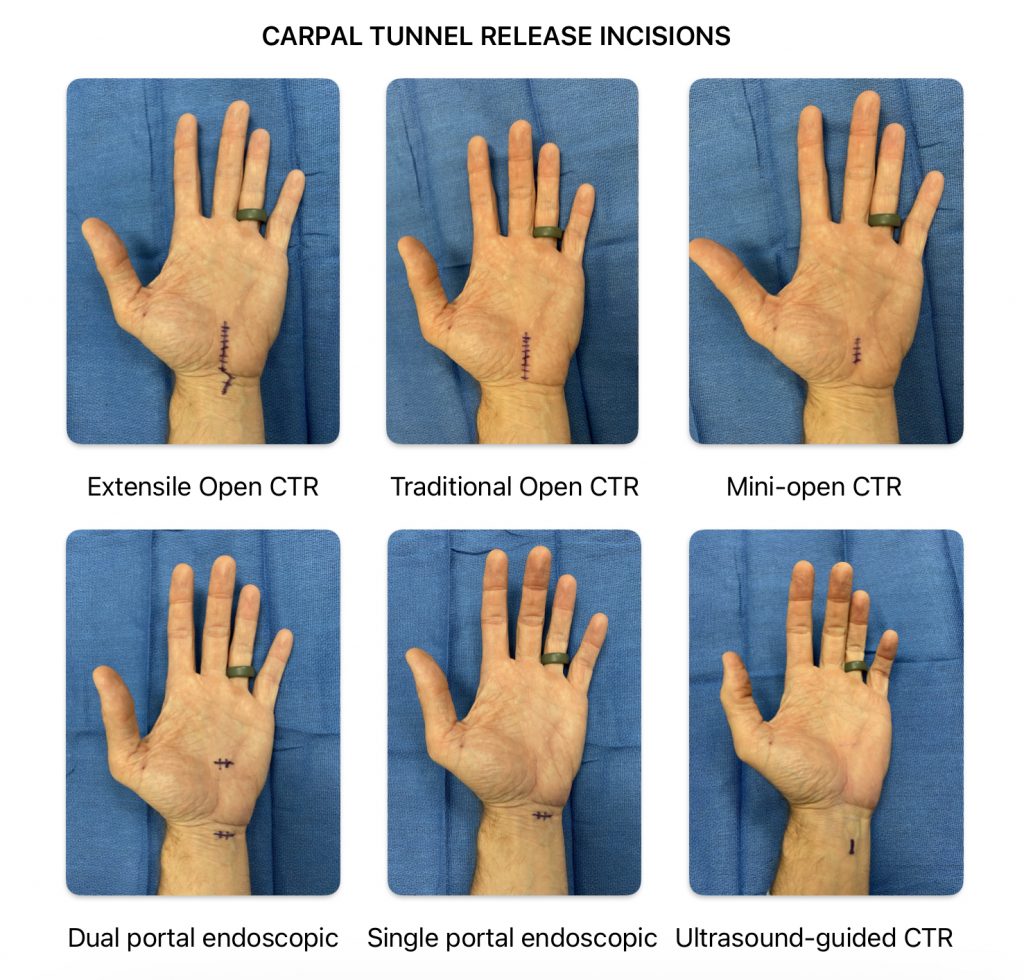Assessment of the Incidence and Predictors of Revision Surgery Following Carpal Tunnel Release 